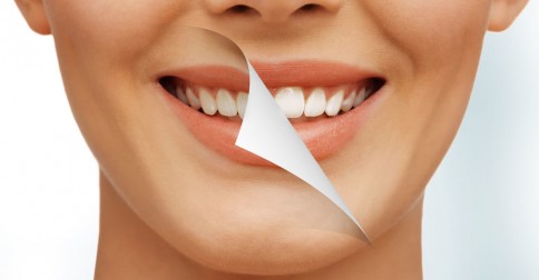 Mitos e Verdades sobre Clareamento Dental
