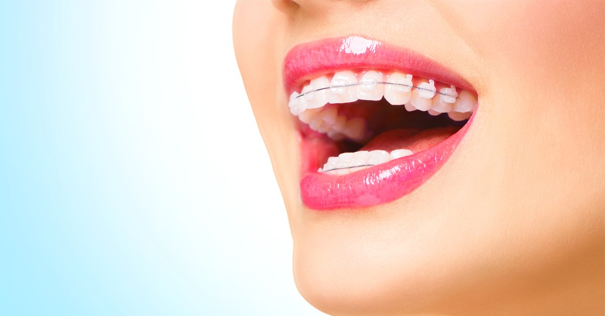Conheça e entenda o principal diferencial da Ortodontia Estética