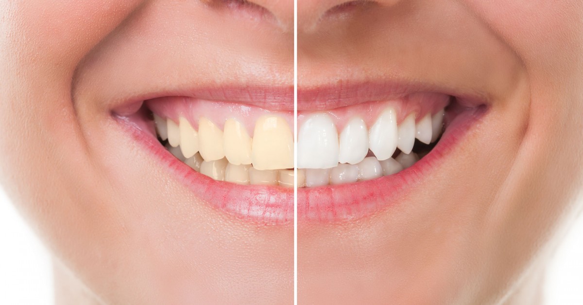 Dentes Brancos: Lentes de Contato ou Clareamento?