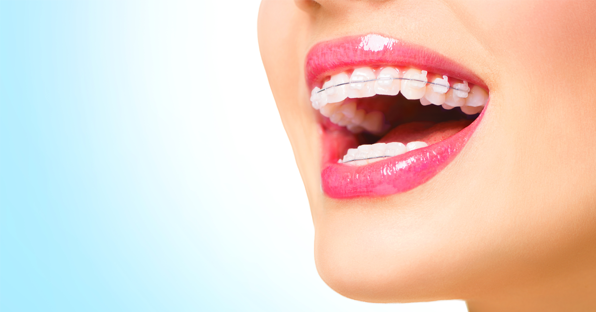 Ortodontia estética