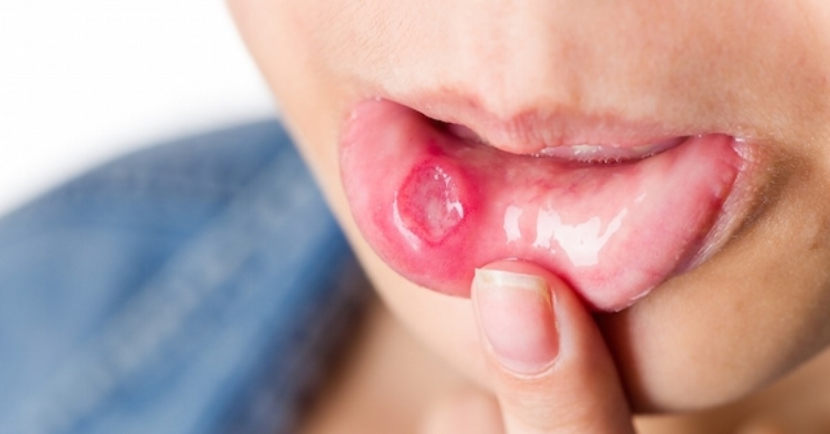 Câncer de boca: sintomas, tratamento e a importância do diagnóstico precoce.